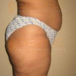 Non Invasive Body Contouring Low Cost in Pune