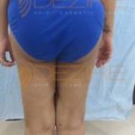 Non Invasive Body Contouring Recover in Pune