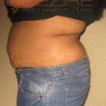 Non Invasive Body Contouring Side Effect in Pune
