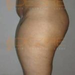 Non Invasive Fat Reduction in Pune