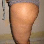 Non Invasive Weight Loss Pune