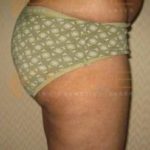 Non Invasive Weight Loss in Pune