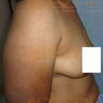 Non Liposuction Fat Removal Cost in Pune