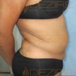 Non Liposuction Fat Removal in Pune Pune