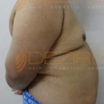 Non Surgical Arm Fat Removal Low Cost in Pune