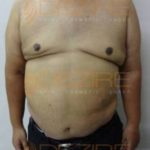 Non Surgical Arm Fat Removal Post Care in Pune