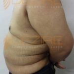 Non Surgical Arm Fat Removal Safe Or Not in Pune