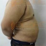 Non Surgical Arm Fat Removal Success Pune