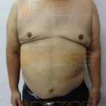 Non Surgical Arm Fat Removal in Before After Pune