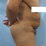 Non Surgical Arm Fat Removal in Low Cost Pune