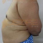 Non Surgical Arm Fat Removal in Pune