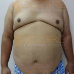 Non Surgical Arm Fat Removal in Pune India