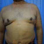 Non Surgical Belly Fat Removal in Pune