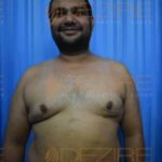 Non Surgical Belly Fat Removal in Pune India
