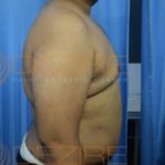 Non Surgical Belly Fat Removal in Pune World