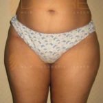 Non Surgical Body Contouring Picture, Images In Pune