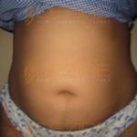 Non Surgical Body Contouring in Pune