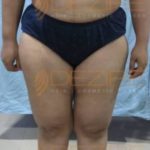 Non Surgical Fat Loss Treatments in Pune