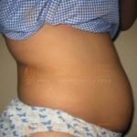 Non Surgical Fat Removal From Stomach Before After Images Pune