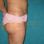 Non Surgical Fat Removal From Stomach Low Price Pune