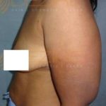 Non Surgical Fat Removal Procedures in Pune