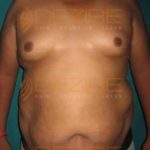 Non Surgical Fat Removal in Pune