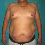 Non Surgical Fat Removal in Pune India
