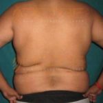 Non Surgical Fat Removal in Pune World
