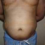 Non Surgical Liposuction in Pune
