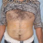 Non Surgical Stomach Fat Removal Pune