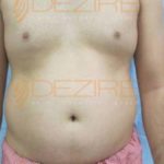 Non Surgical Stomach Fat Removal in Pune India