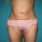 Non Surgical Weight Loss Possible PuneNon Surgical Weight Loss Possible Pune