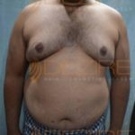 Plastic Surgery To Remove Belly Fat Before After Photo in Pune