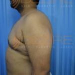 Plastic Surgery To Remove Belly Fat Loss in Pune