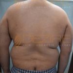 Plastic Surgery To Remove Belly Fat in Pune