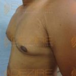 Remove Belly Fat Without Surgery Before After Photo Pune