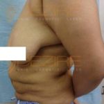 Sculpture Laser Fat Removal in Pune
