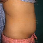 Smart Lipo Procedure Before And After Images In Pune