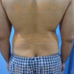 Smart Liposuction Procedure in Pune