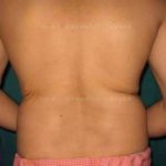Stomach Fat Removal Surgery Before After Picture