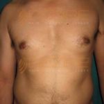 Stomach Fat Removal Surgery Cost in Pune