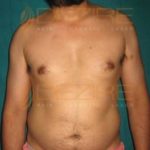 Stomach Fat Removal Surgery Cost in Pune India