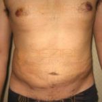 Stomach Fat Removal Surgery Images Pune