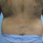 Stomach Fat Removal Surgery Low in Pune