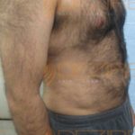 Stomach Fat Removal Surgery Price in Pune