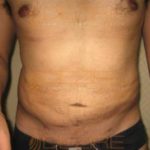 Stomach Fat Removal Surgery Type Pune