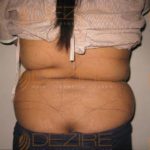 Stomach Fat Removal Surgery cost Pune