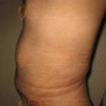 Stomach Fat Removal Surgery in Pune
