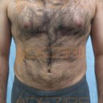 Stomach Fat Removal Surgery in Pune India