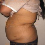 Stomach Fat Removal Surgery in Pune World